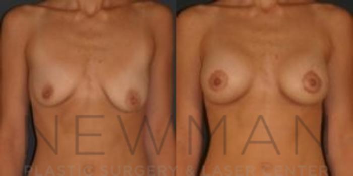 Before & After Breast Lift with Augmentation Case 57 Front View in Westchester County & Long Island, NY