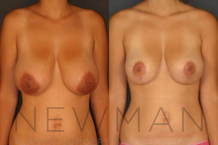 Before & After Breast Reduction Case 27 Front View in Westchester County & Long Island, NY