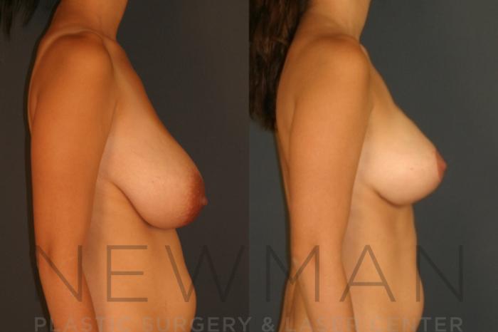 Before & After Breast Reduction Case 27 Right Side View in Westchester County & Long Island, NY