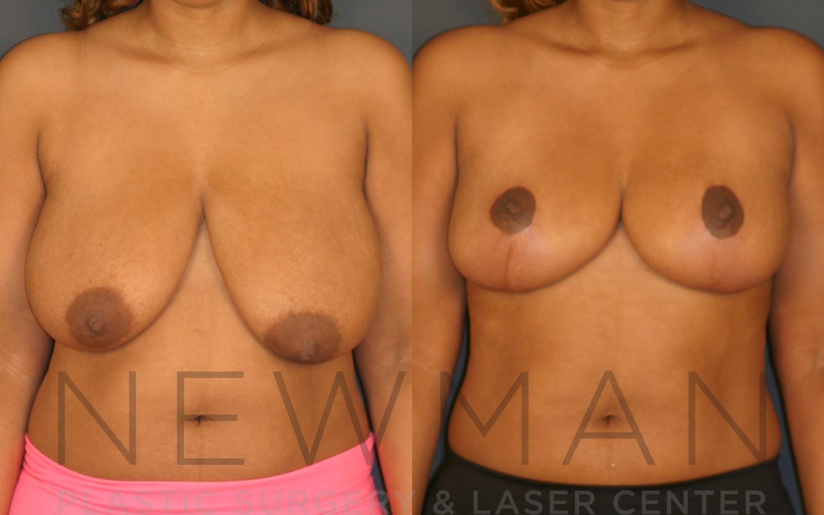 Before & After Breast Reduction Case 28 Front View in Westchester County & Long Island, NY