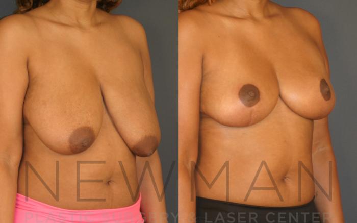 Before & After Breast Reduction Case 28 Right Oblique View in Westchester County & Long Island, NY