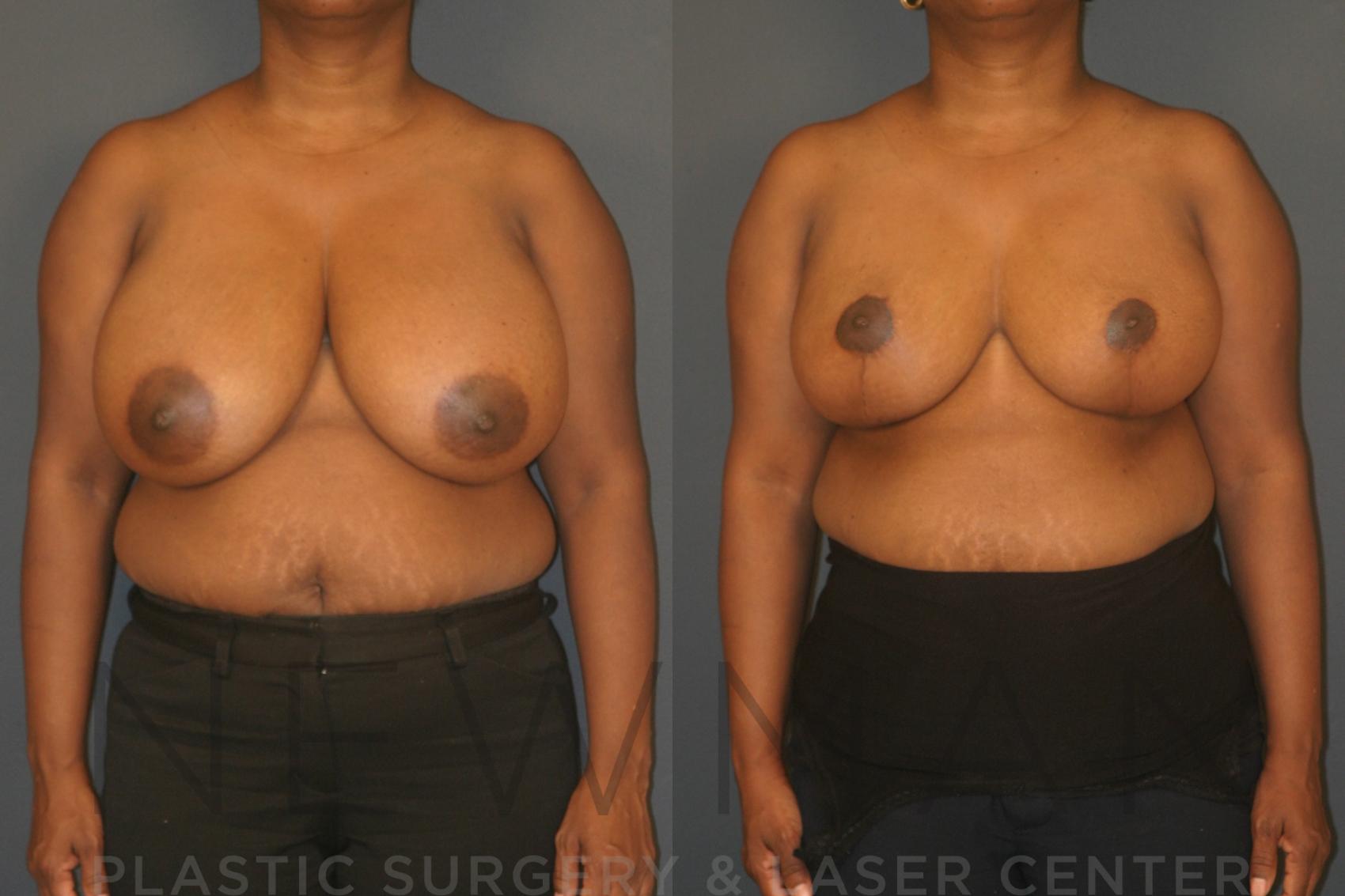Before & After Breast Reduction Case 29 Front View in Yonkers, NY