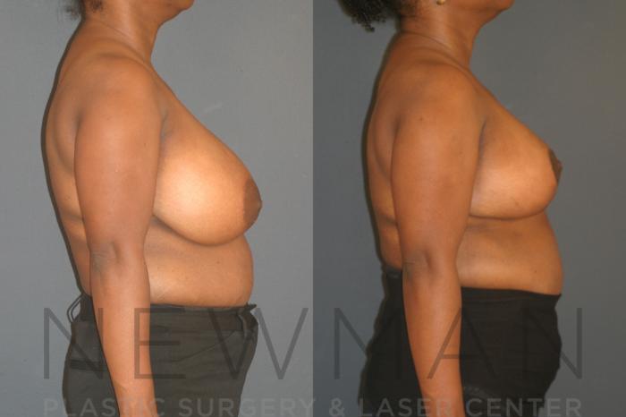 Before & After Breast Reduction Case 29 Right Side View in Westchester County & Long Island, NY