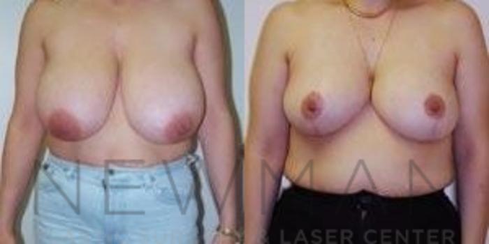 Before & After Breast Reduction Case 40 Front View in Westchester County & Long Island, NY