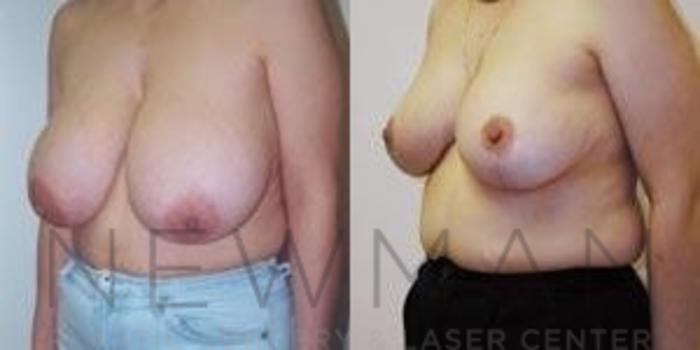 Before & After Breast Reduction Case 40 Left Oblique View in Westchester County & Long Island, NY