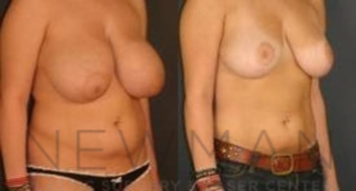 Before & After Breast Reduction Case 41 Right Oblique View in Westchester County & Long Island, NY
