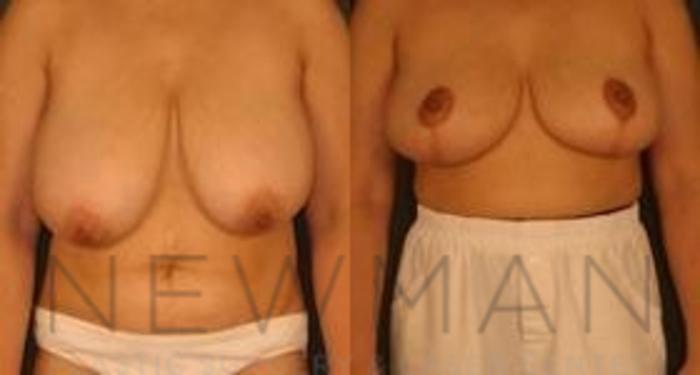 Before & After Breast Reduction Case 42 Front View in Westchester County & Long Island, NY