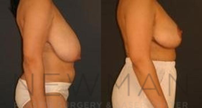 Before & After Breast Reduction Case 42 Right Side View in Westchester County & Long Island, NY