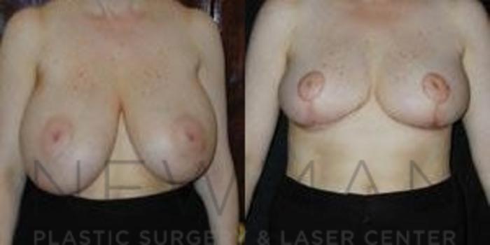 Before & After Breast Reduction Case 43 Front View in Westchester County & Long Island, NY