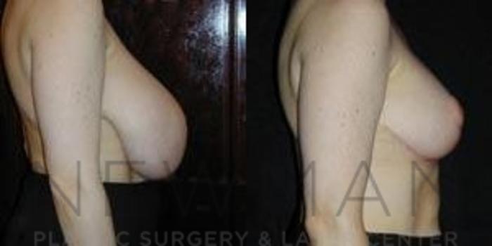 Before & After Breast Reduction Case 43 Right Side View in Westchester County & Long Island, NY