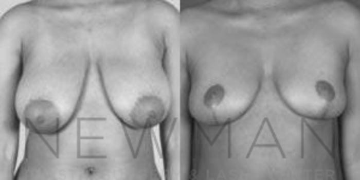 Before & After Breast Reduction Case 44 Front View in Westchester County & Long Island, NY