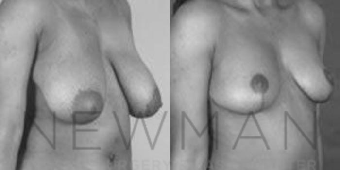 Before & After Breast Reduction Case 44 Right Oblique View in Westchester County & Long Island, NY