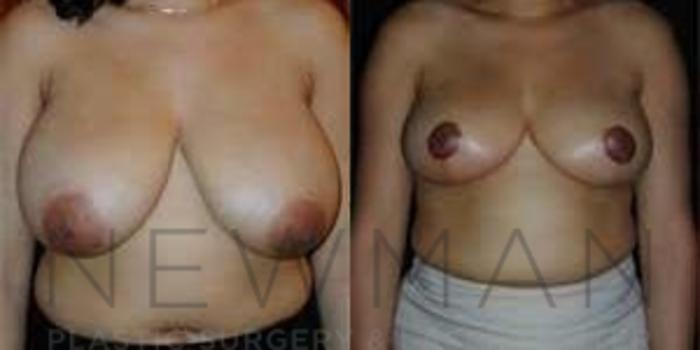 Before & After Breast Reduction Case 45 Front View in Westchester County & Long Island, NY