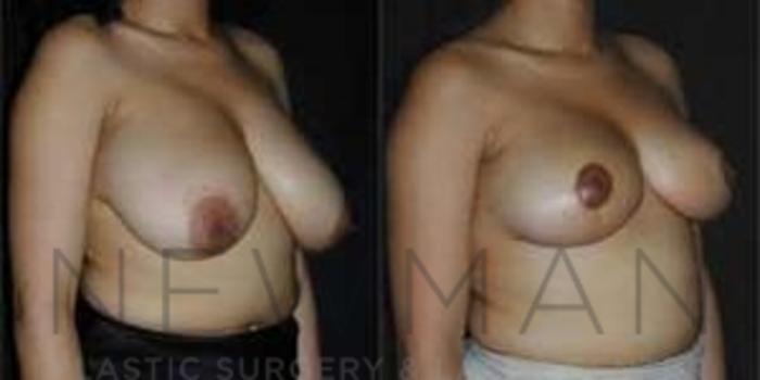 Before & After Breast Reduction Case 45 Right Oblique View in Westchester County & Long Island, NY