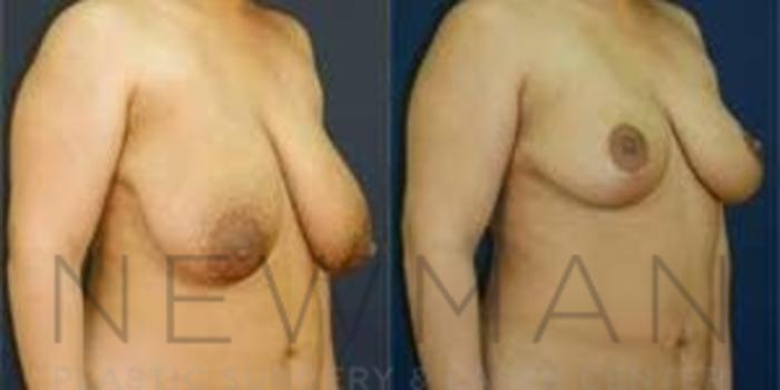 Before & After Breast Reduction Case 46 Right Oblique View in Westchester County & Long Island, NY