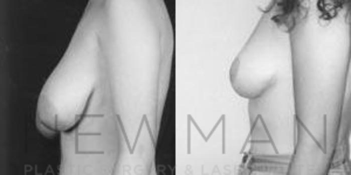 Before & After Breast Reduction Case 47 Left Side View in Westchester County & Long Island, NY