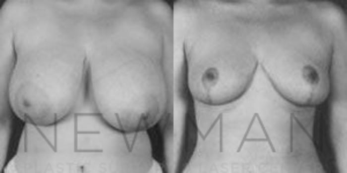 Before & After Breast Reduction Case 48 Front View in Westchester County & Long Island, NY