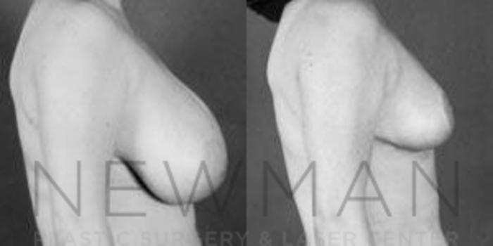 Before & After Breast Reduction Case 48 Right Side View in Westchester County & Long Island, NY