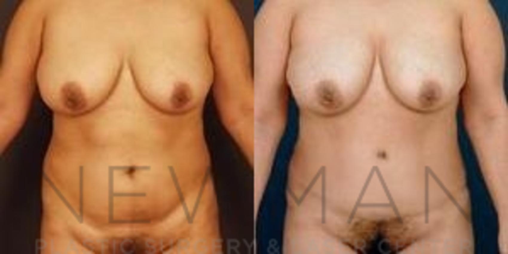 Before & After Tummy Tuck Case 30 Front View in Westchester County & Long Island, NY