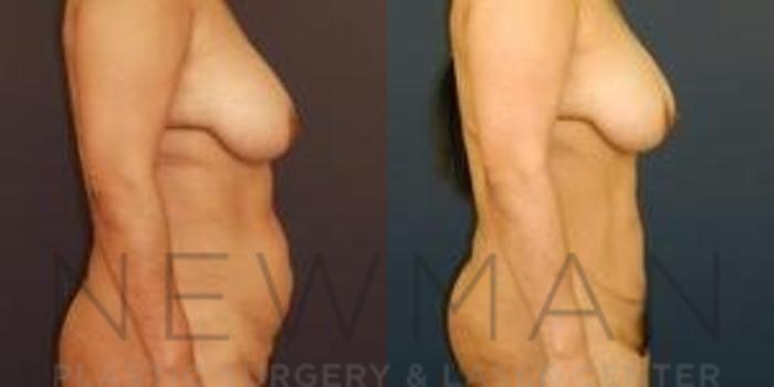 Before & After Tummy Tuck Case 30 Right Side View in Westchester County & Long Island, NY