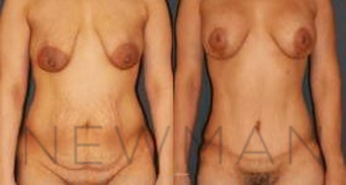 Before & After Tummy Tuck Case 31 Front View in Yonkers, NY