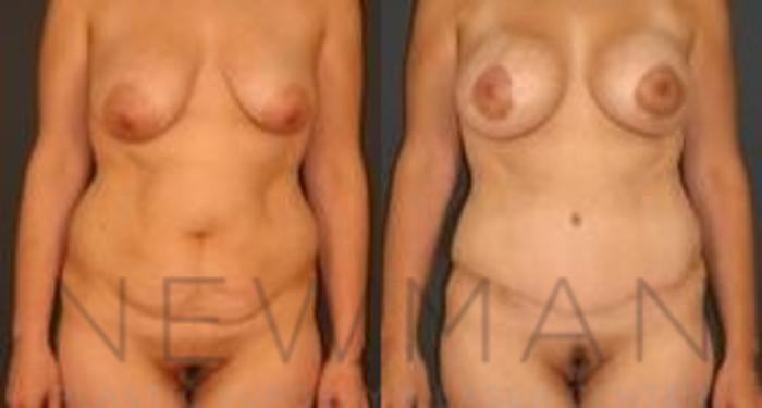 Before & After Tummy Tuck Case 32 Front View in Yonkers, NY