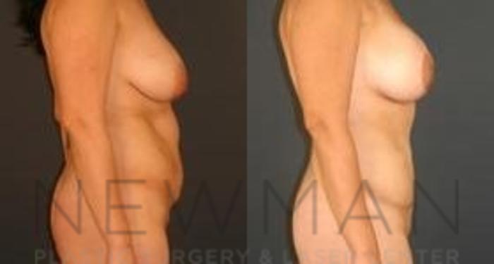 Before & After Tummy Tuck Case 32 Right Side View in Westchester County & Long Island, NY