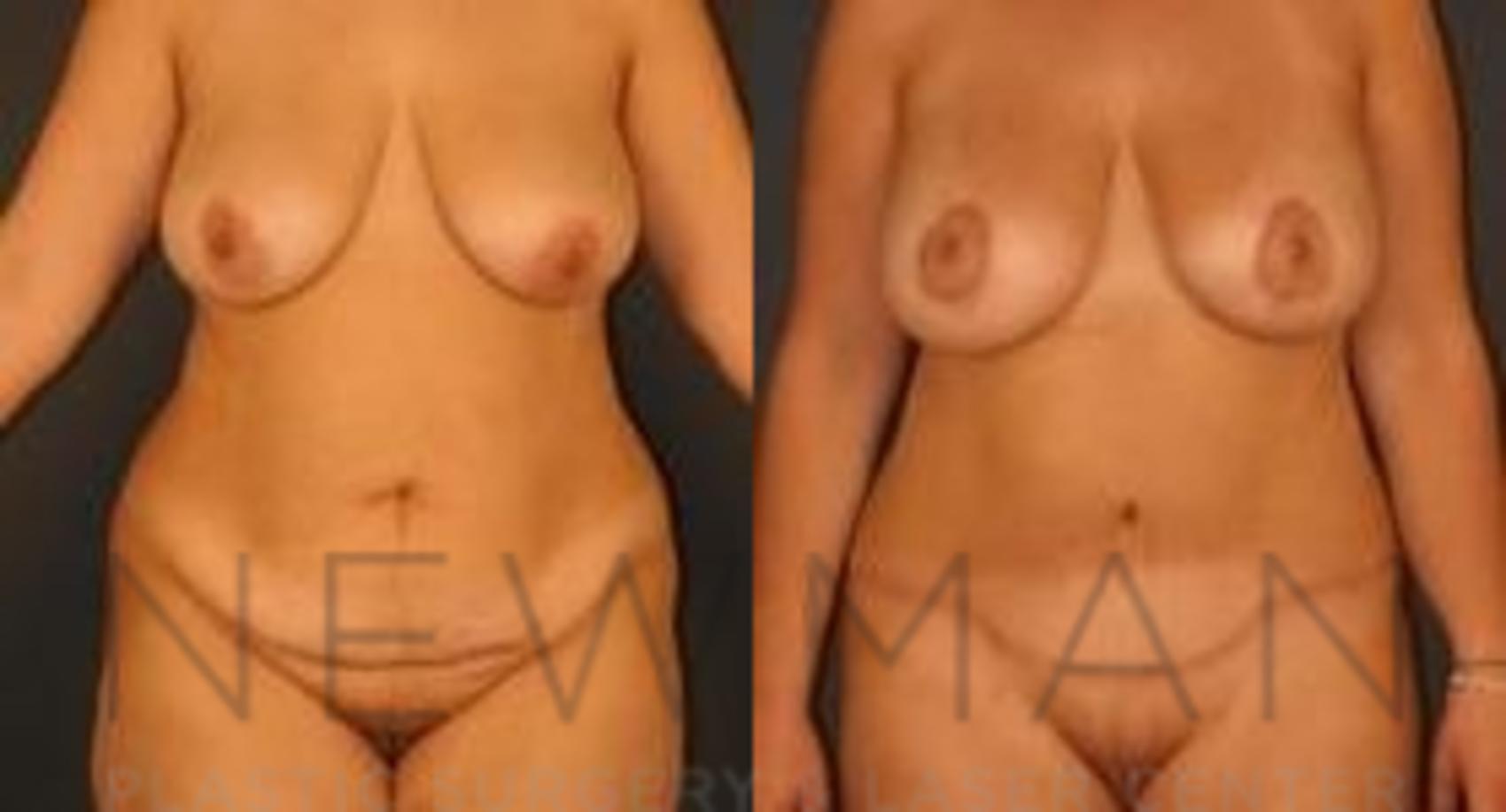Before & After Tummy Tuck Case 33 Front View in Westchester County & Long Island, NY