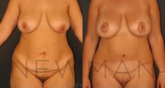 Before & After Tummy Tuck Case 33 Front View in Yonkers, NY