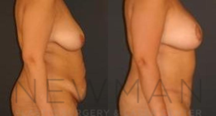 Before & After Tummy Tuck Case 33 Right Side View in Westchester County & Long Island, NY