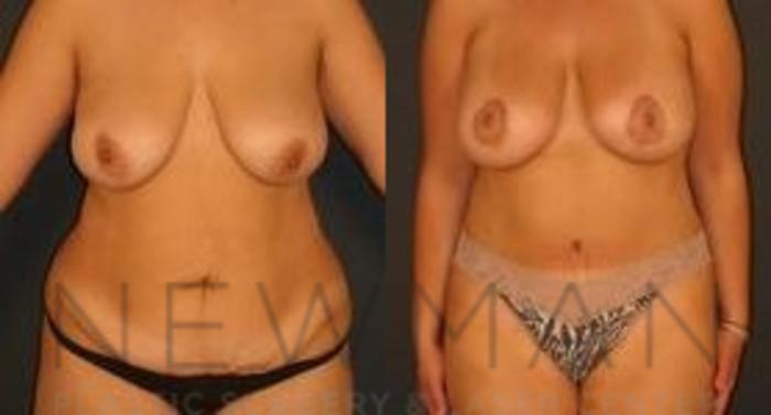 Before & After Tummy Tuck Case 34 Front View in Yonkers, NY