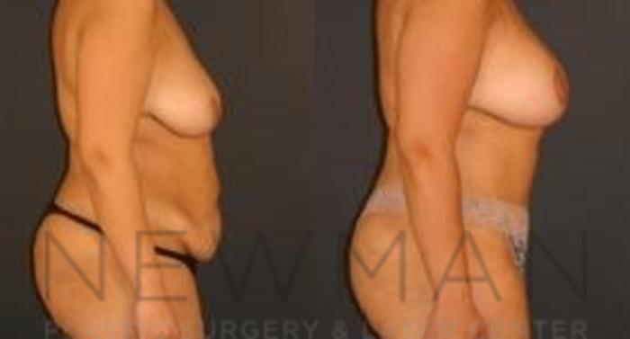 Before & After Tummy Tuck Case 34 Right Side View in Westchester County & Long Island, NY