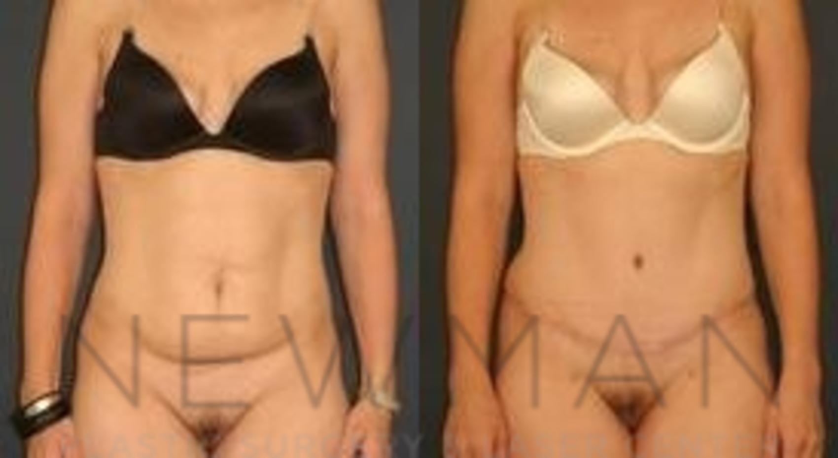 Before & After Tummy Tuck Case 35 Front View in Westchester County & Long Island, NY