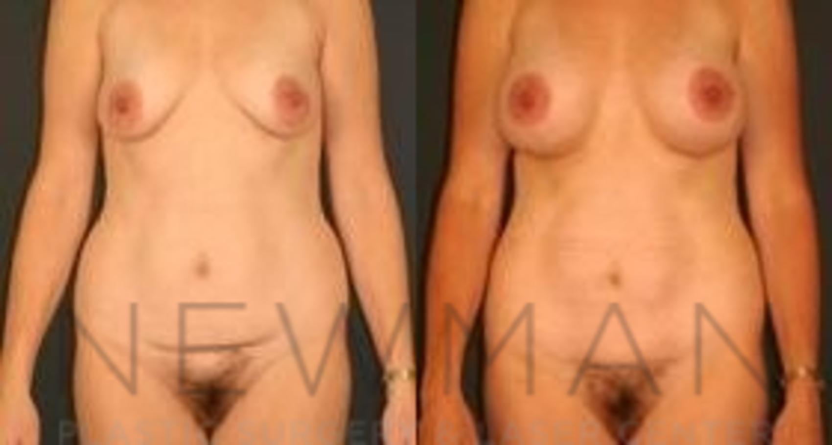 Before & After Tummy Tuck Case 36 Front View in Yonkers, NY