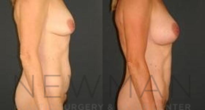 Before & After Tummy Tuck Case 36 Right Side View in Westchester County & Long Island, NY