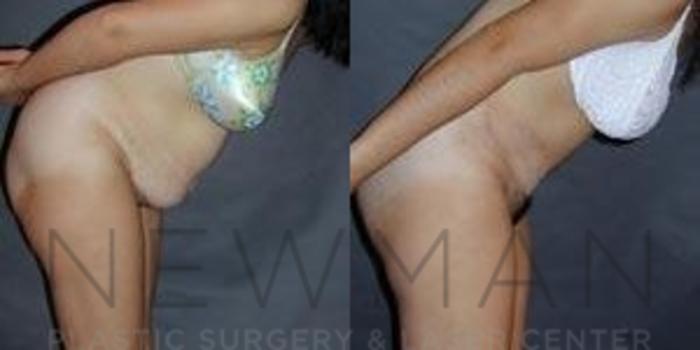Before & After Tummy Tuck Case 37 Right Side View in Westchester County & Long Island, NY