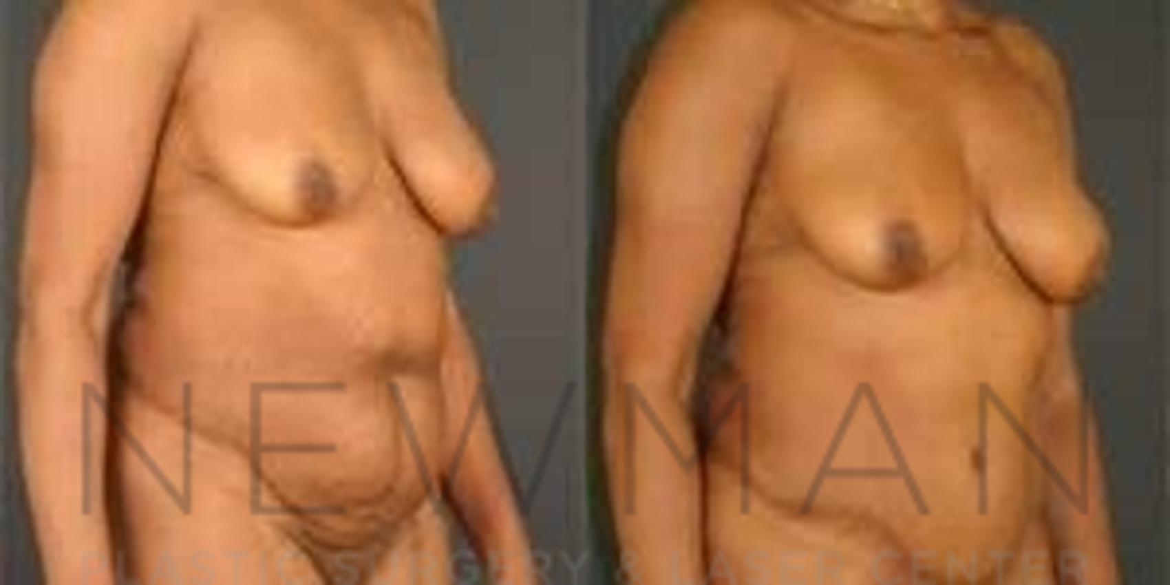 Before & After Tummy Tuck Case 38 Right Oblique View in Westchester County & Long Island, NY