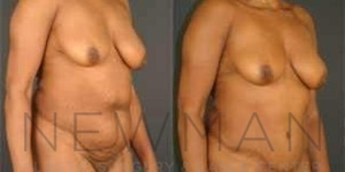 Before & After Tummy Tuck Case 38 Right Oblique View in Yonkers, NY