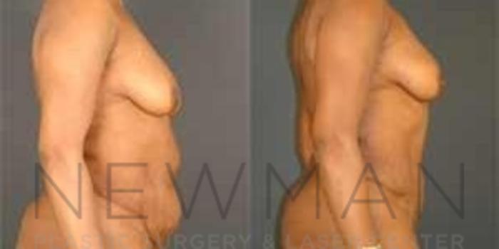 Before & After Tummy Tuck Case 38 Right Side View in Westchester County & Long Island, NY