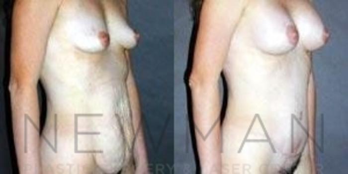 Before & After Tummy Tuck Case 39 Right Oblique View in Westchester County & Long Island, NY